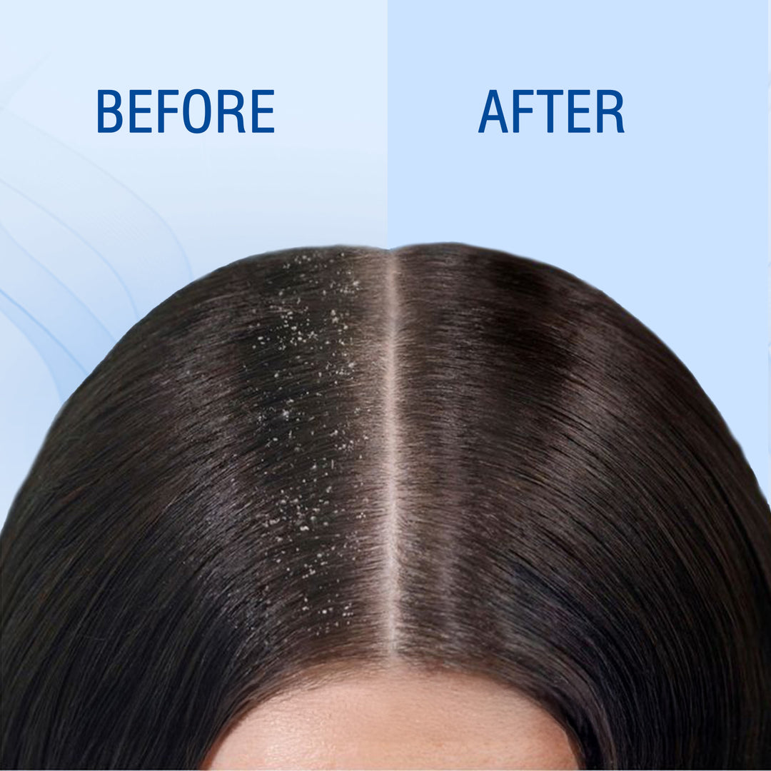 Hairshield Anti Dandruff Shampoo 60ml with Free 10ml Anti Dandruff Cream | Climbazole, ZPTO, Neem & Peppermint Formula | Prevents Recurrence, Hydrates & Conditions Hair | Powerful Duo for Men & Women