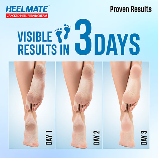 Heelmate Cracked Heel Repair (50g) (Pack Of 2) Specialist Cream Ointment | Made with AquaMagnet Technology and 8 Powerful Ingredients | 3 Days Results Guaranteed