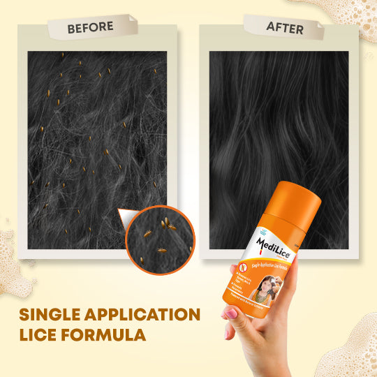 MEDILICE Cream Wash (Pack of 6) | Clinically Proven Single Application Lice Removal Formula  | Removes Lice, Nits, Eggs, & Nymphs | Since 1998