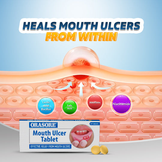 Orasore Mouth Ulcer Tablet (Pack of 4) |Contains Vitamin B2, B3, B9 and Probiotics | Provides All Round Essential Supplements to Body for Oral Ulcer Control | Free Pen Inside Every Pack